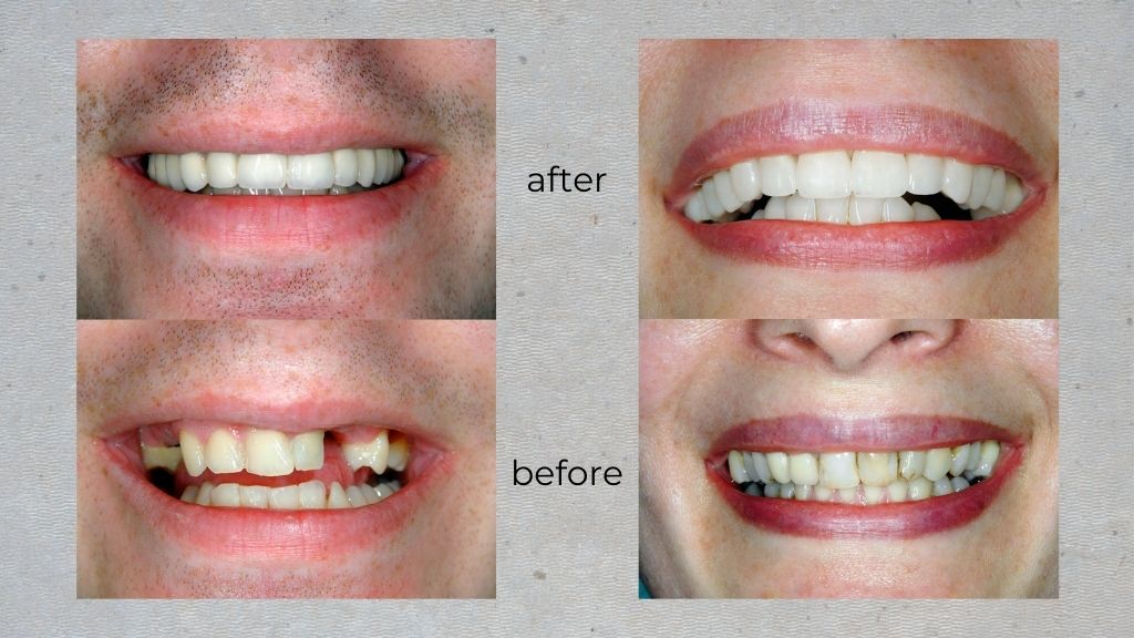 before after calgary dentist nw