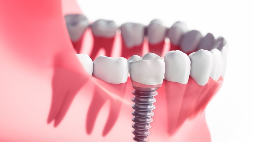 dental implants calgary nw