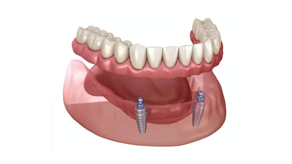 implant supported dentures calgary nw