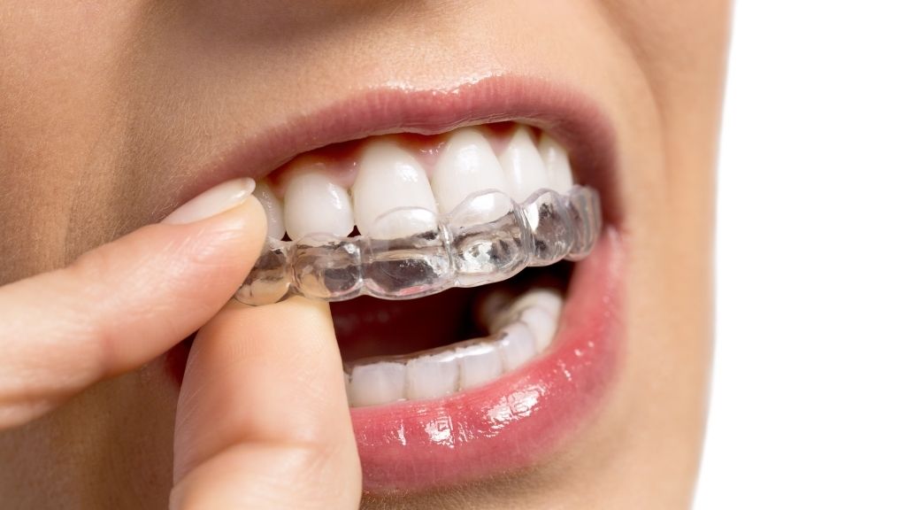 orthodontics invisalign calgary nw