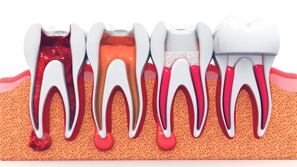 root canal calgary nw