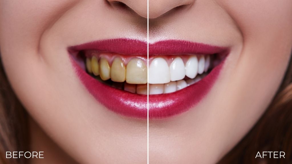 teeth whitening calgary nw