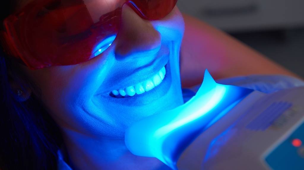 laser teeth whitening calgary nw