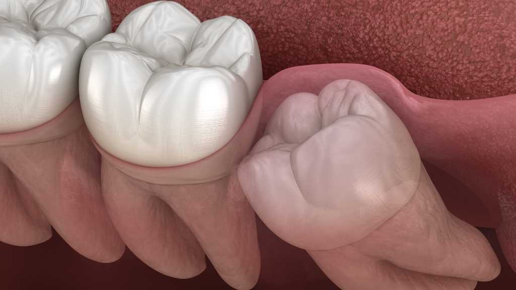 wisdom teeth removal calgary nw impacted wisdom tooth